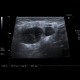 Inflammatory lymph node with liquefaction: US - Ultrasound